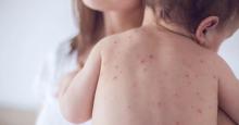 Measles incidence steadily decreasing in Kyrgyzstan